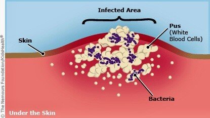 Abscess / Carbuncle / Boils