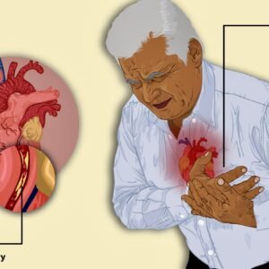 Angina