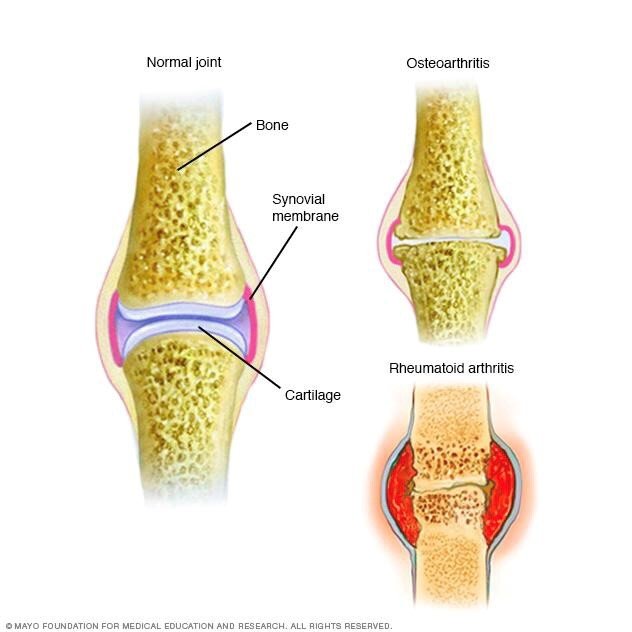 Arthritis, Osteo