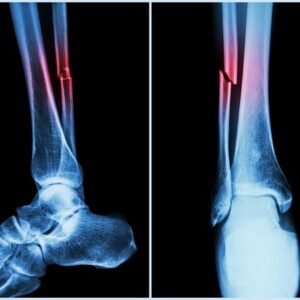 Bones, Broken (fractures)