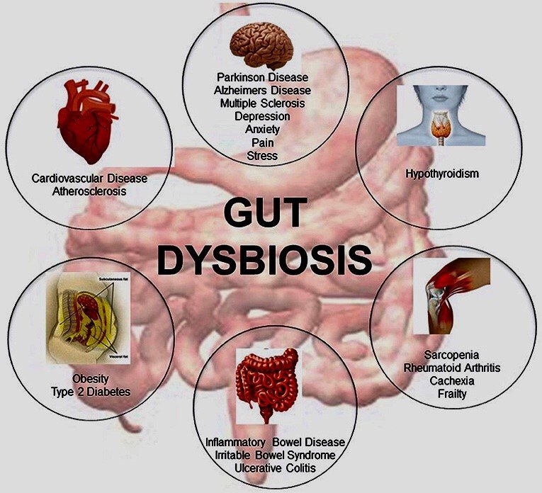 Bowel Flora Restoration (Gut Dysbiosis)