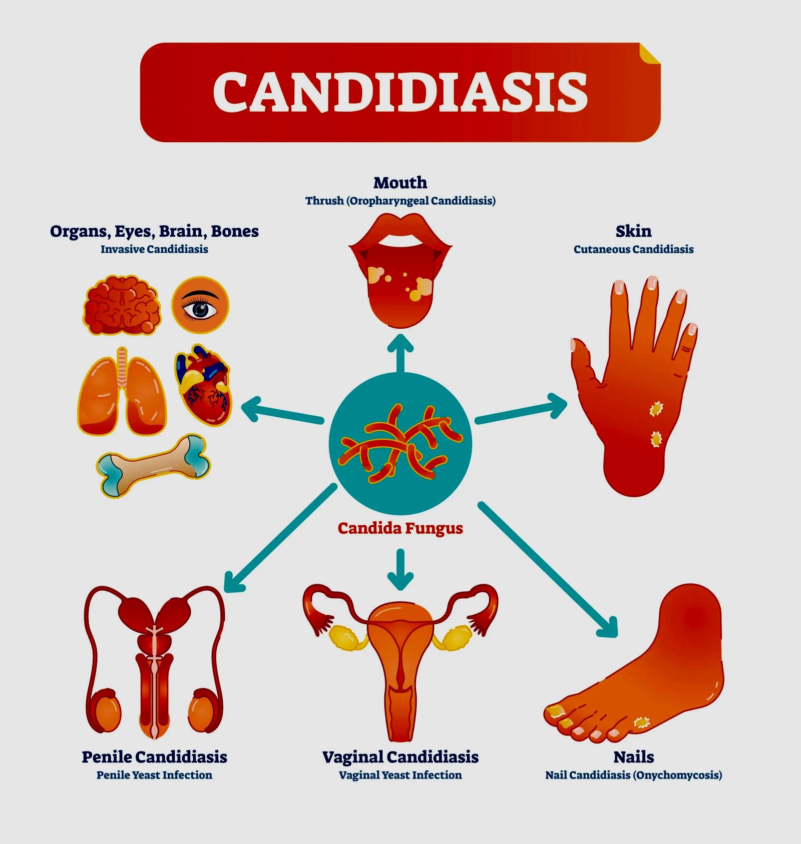Candida