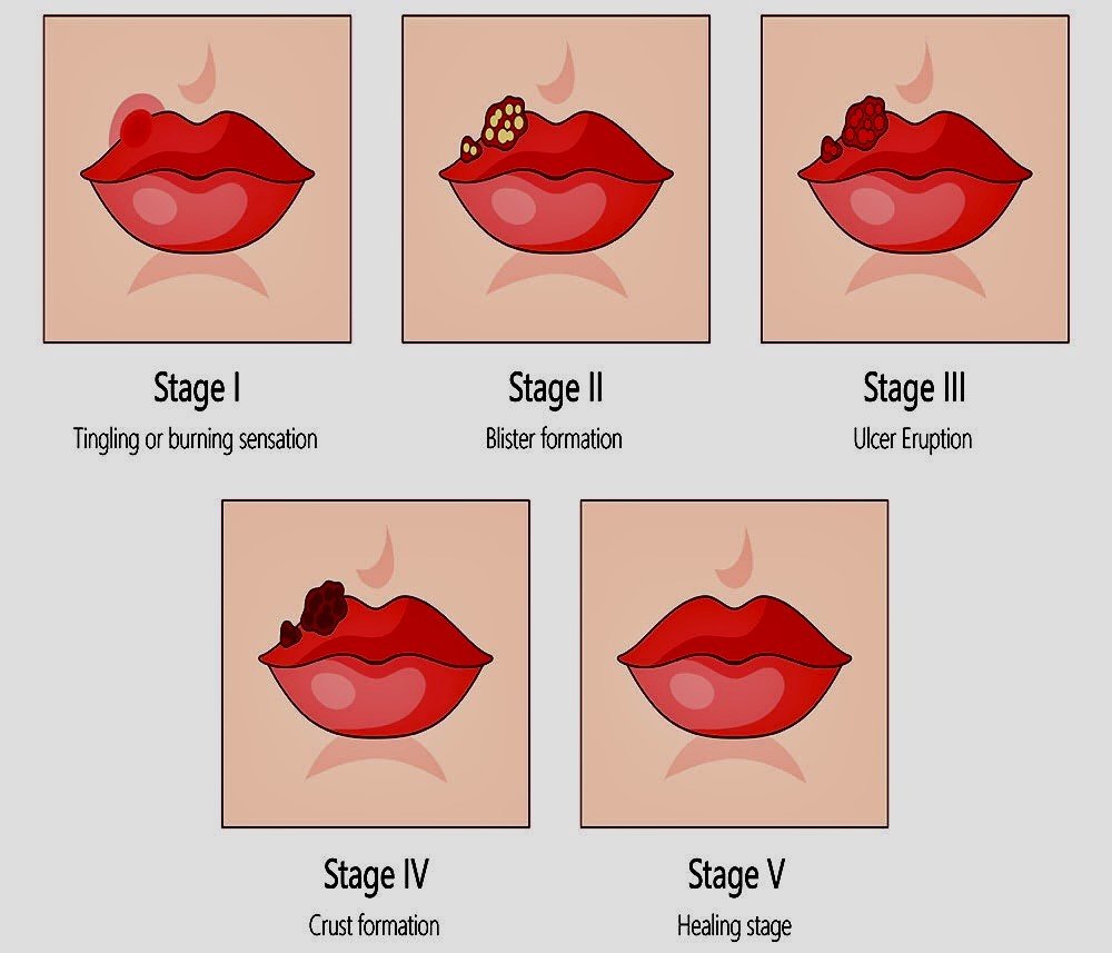 Cold Sores