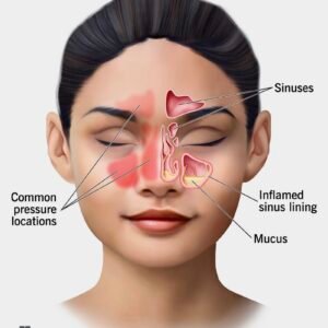 Sinus Infection