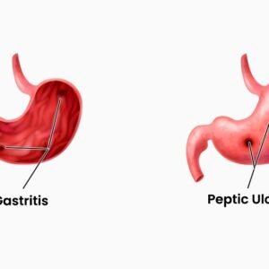 Stomach Ulcer/ Gastritis
