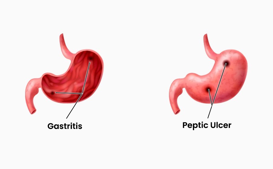Stomach Ulcer/ Gastritis