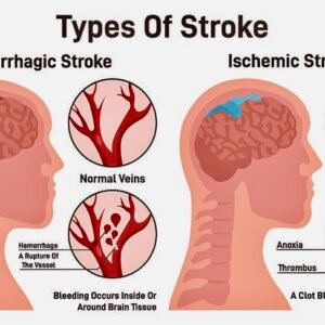 Stroke (Recovery)