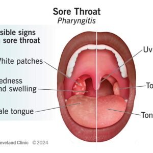 Sore Throat