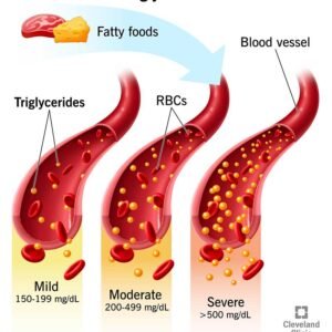 Triglycerides (High)