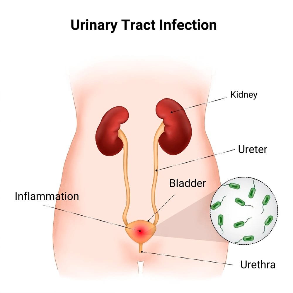 Urinary Tract Infection