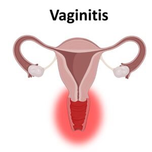 Vaginitis