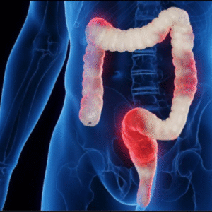 Colitis (Chronic; Crohn’s Disease;Ulcerative Colitis)