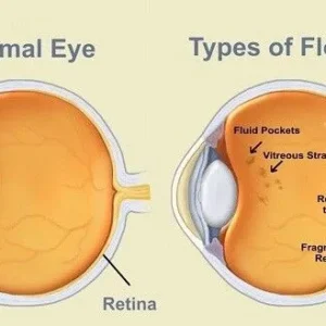 Eye, Floaters