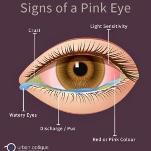 Conjunctivitis (pink eye)