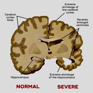 Dementia