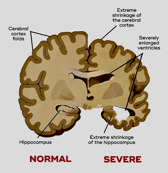 Dementia
