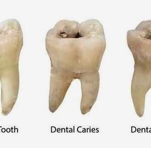 Dental Caries