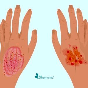 Eczema