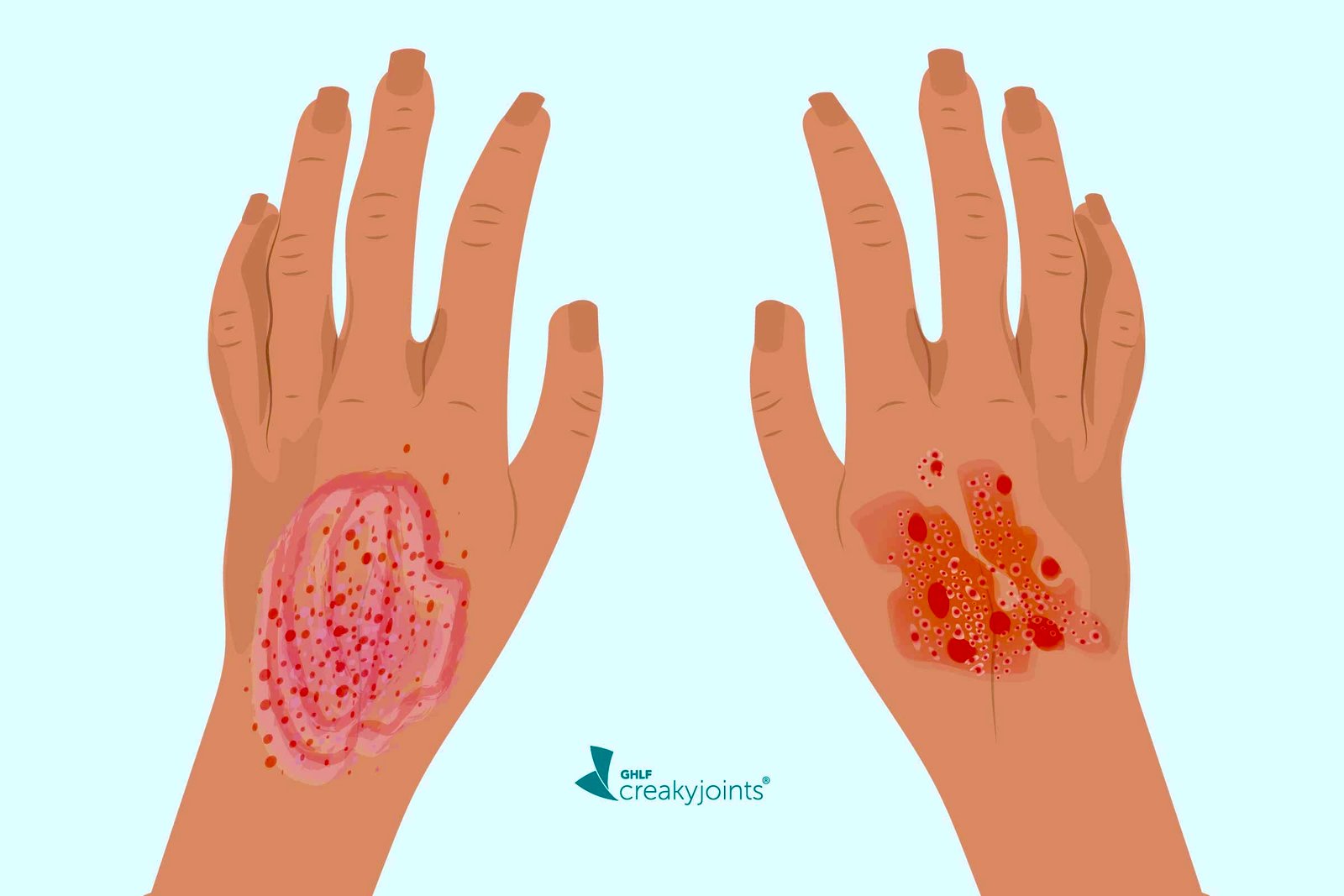 Eczema