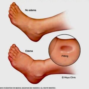 Edema (Swelling, especially in lower extremities, ankles)
