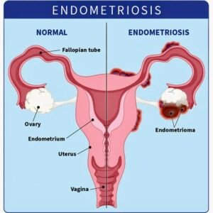 Endometriosis