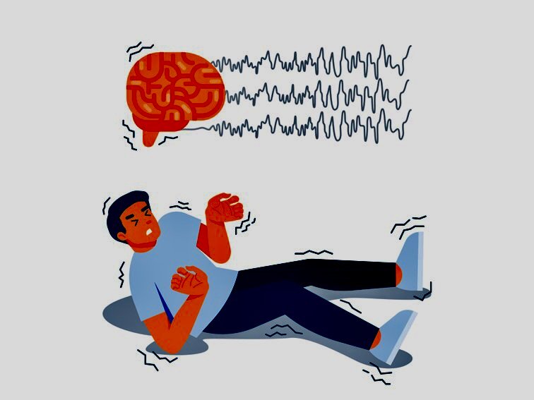 Epilepsy