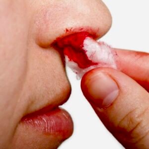 Epistaxis (nosebleed)