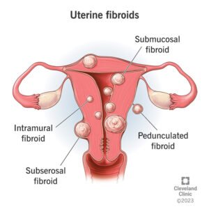 Fibroids, Uterine