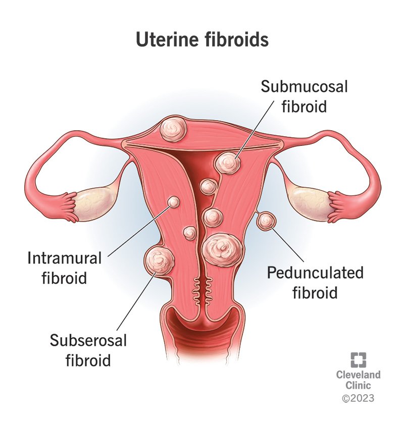 Fibroids, Uterine
