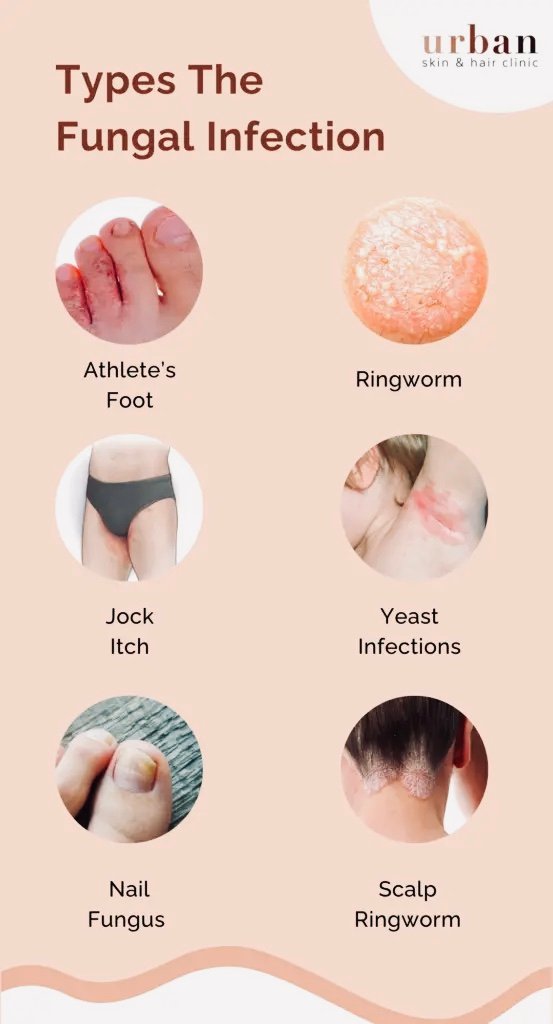 Fungus Infection