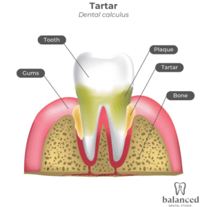 Dental Tartar & Plaque Protocol