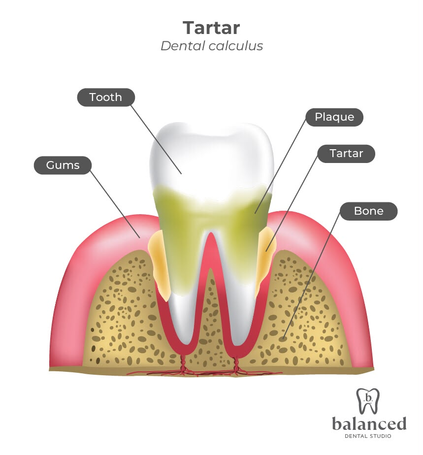 Dental Tartar & Plaque Protocol